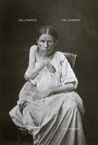 AVQ-A-000200-0025 - Portrait of young woman affected by hemiplegic epilepsy. The patient shows her upper right limb atrophied by the disease - Date of photography: 1878 - Verchi Marialieta Collection / Alinari Archives, Florence