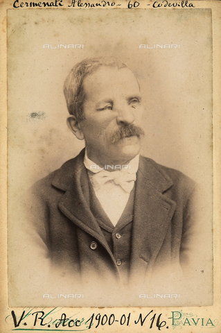BCC-F-001073-0000 - Portrait of Alessandro Cermenti, age 60, affected by a skin disease. - Date of photography: 1900-1901 - Alinari Archives, Florence