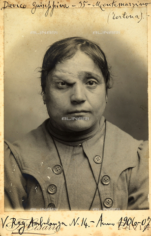 BCC-F-001083-0000 - Portrait of Giuseppina Davico, age 35, suffering from a disease above the eye - Date of photography: 1906-1907 - Alinari Archives, Florence